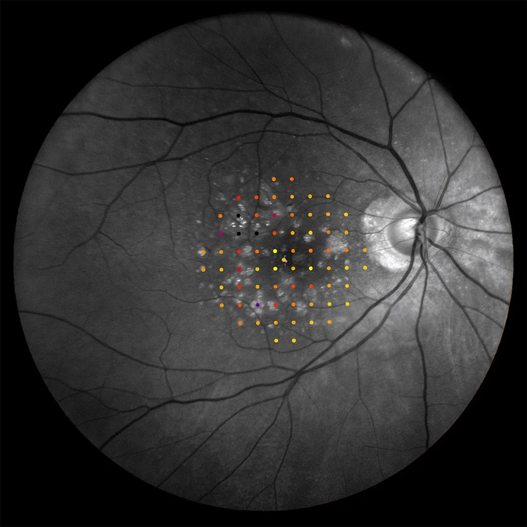 iCare MAIA red-free microperimetry grid showing vascular detail