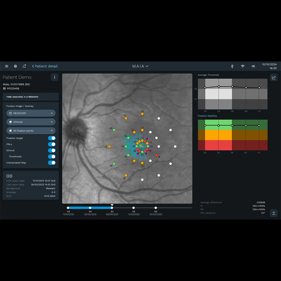 iCare MAIA time analysis showing mesopic sensitivity progression