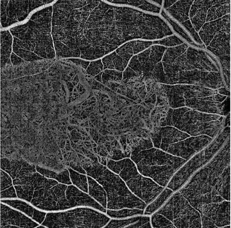 AngioVue OCTA scan of superficial retinal vasculature, 9x9mm field